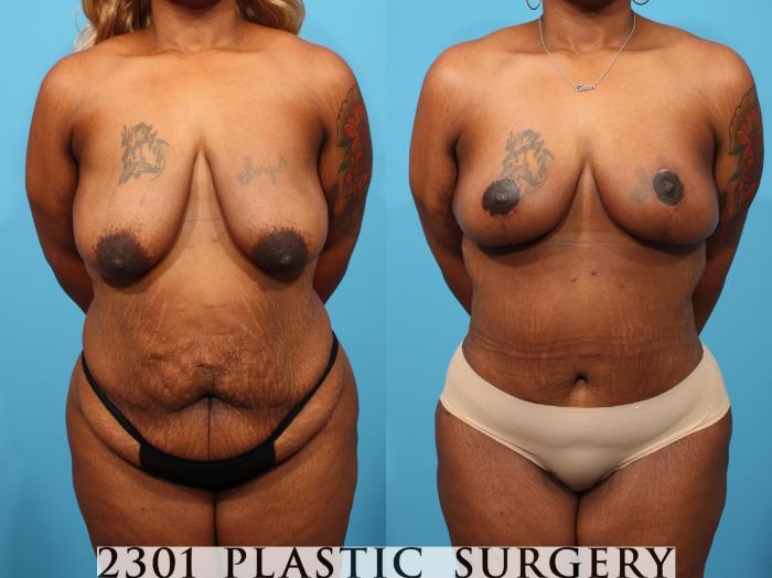 Before & After Tummy Tuck Case 784 Front View in Fort Worth, Plano, & Frisco, Texas