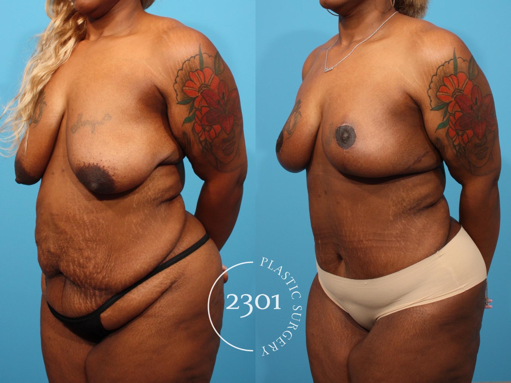 Before & After Tummy Tuck Case 784 Left Oblique View in Fort Worth, Plano, & Frisco, Texas