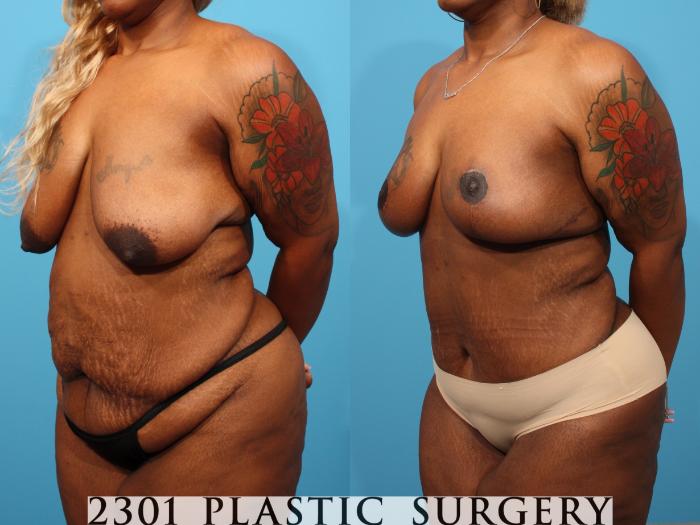 Before & After Post-Bariatric Plastic Surgery Case 784 Left Oblique View in Fort Worth, Plano, & Frisco, Texas