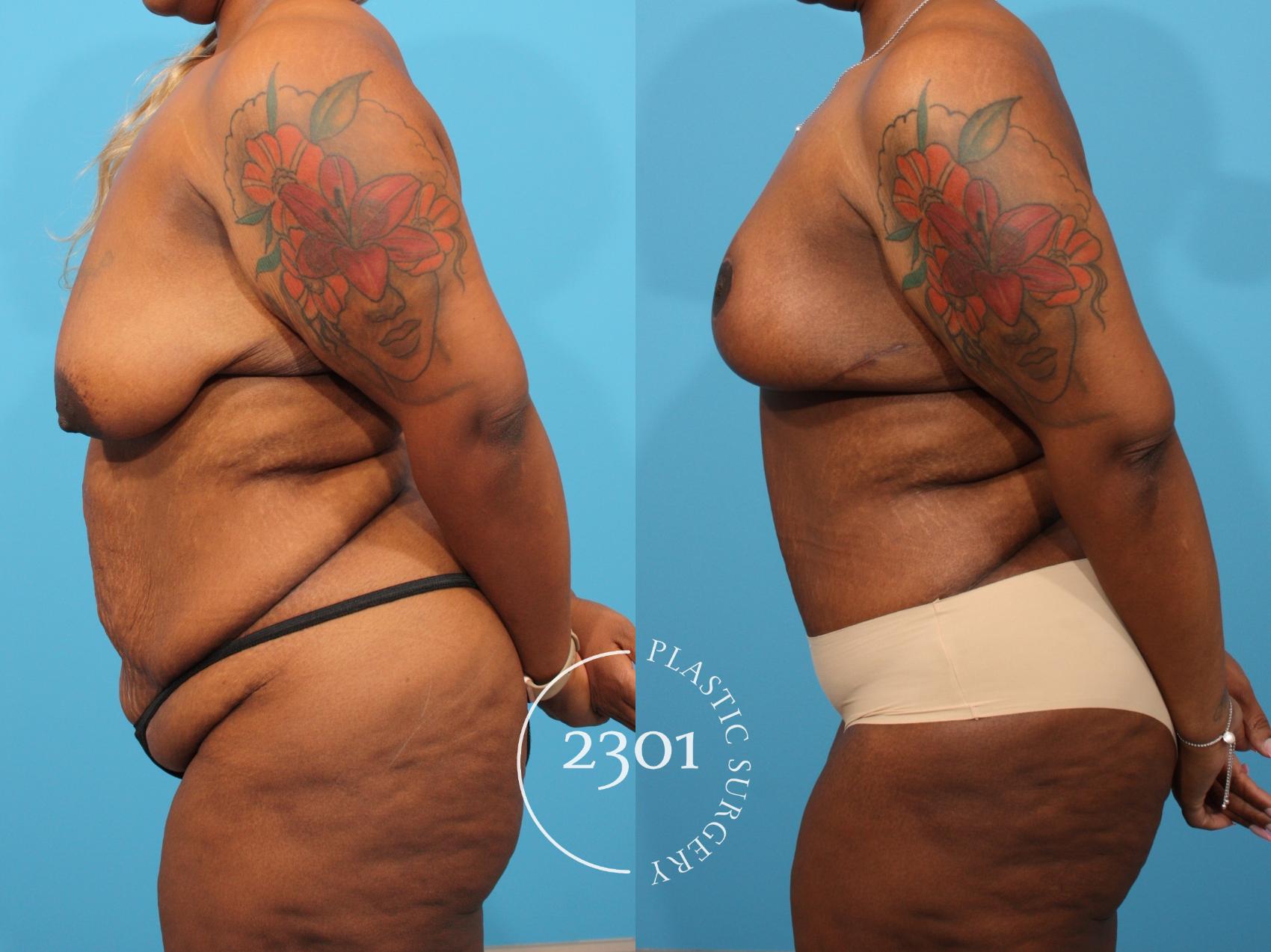 Before & After Tummy Tuck Case 784 Left Side View in Fort Worth, Plano, & Frisco, Texas