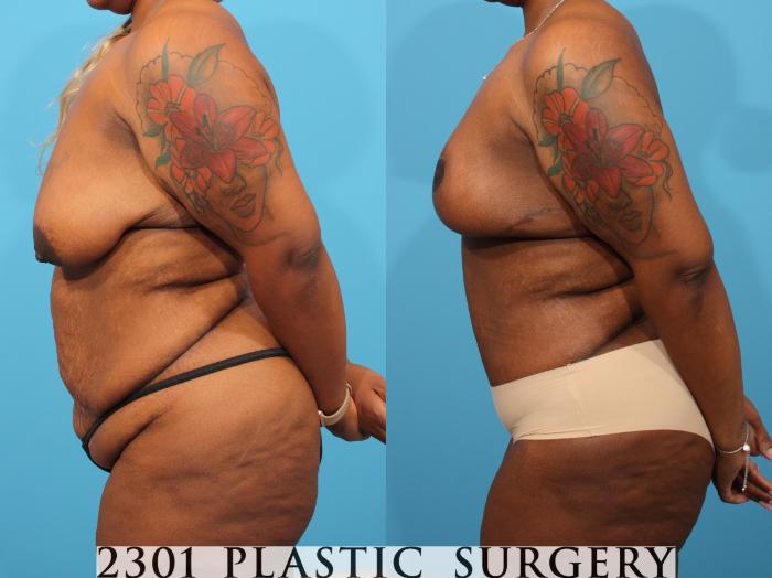 Before & After Post-Bariatric Plastic Surgery Case 784 Left Side View in Fort Worth, Plano, & Frisco, Texas