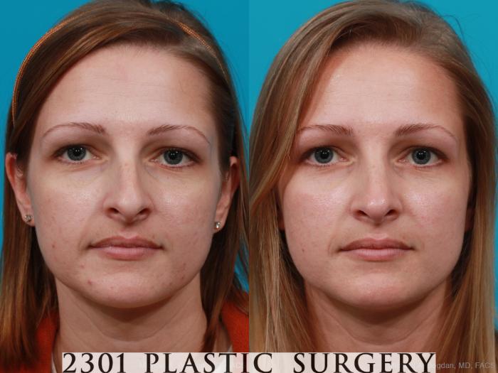 Before & After Rhinoplasty Case 181 View #1 View in Fort Worth & Frisco, Texas