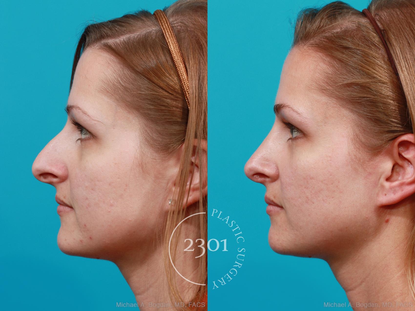 Before & After Rhinoplasty Case 181 View #2 View in Fort Worth, Plano, & Frisco, Texas