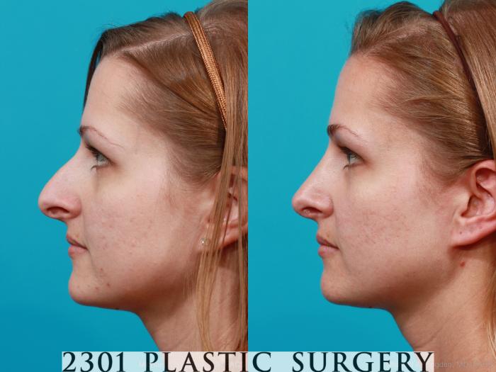 Before & After Rhinoplasty Case 181 View #2 View in Fort Worth, Plano, & Frisco, Texas