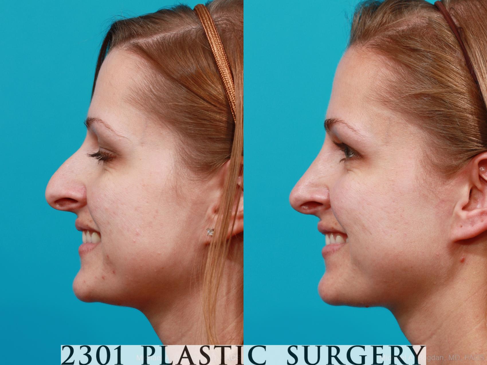 Before & After Rhinoplasty Case 181 View #3 View in Fort Worth, Plano, & Frisco, Texas
