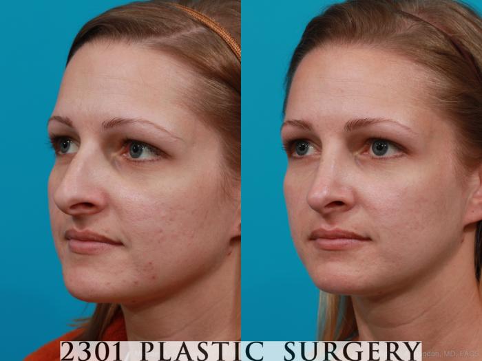 Before & After Rhinoplasty Case 181 View #4 View in Fort Worth, Plano, & Frisco, Texas