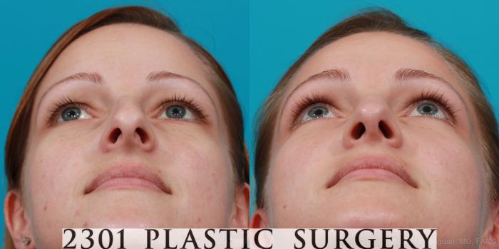 Before & After Rhinoplasty Case 181 View #5 View in Fort Worth, Plano, & Frisco, Texas