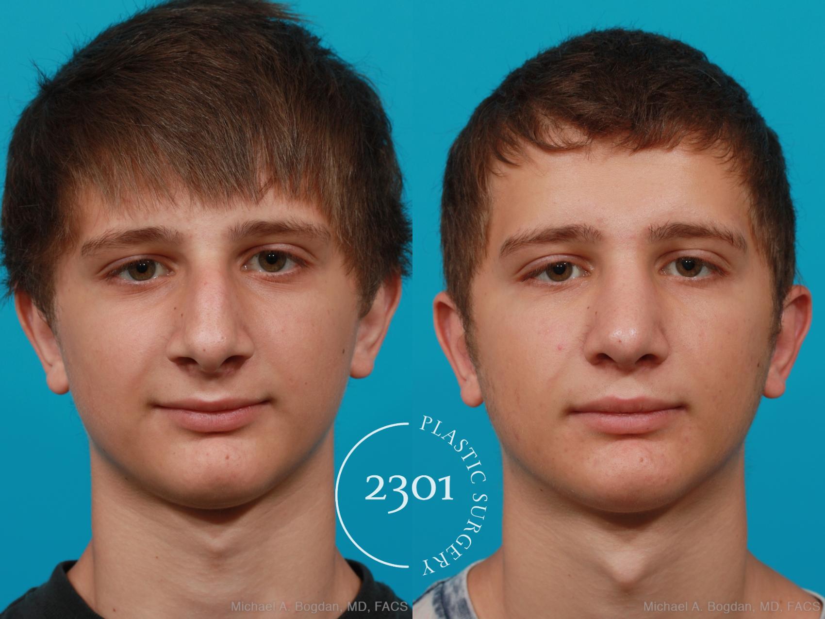 Before & After Rhinoplasty Case 182 View #1 View in Fort Worth, Plano, & Frisco, Texas