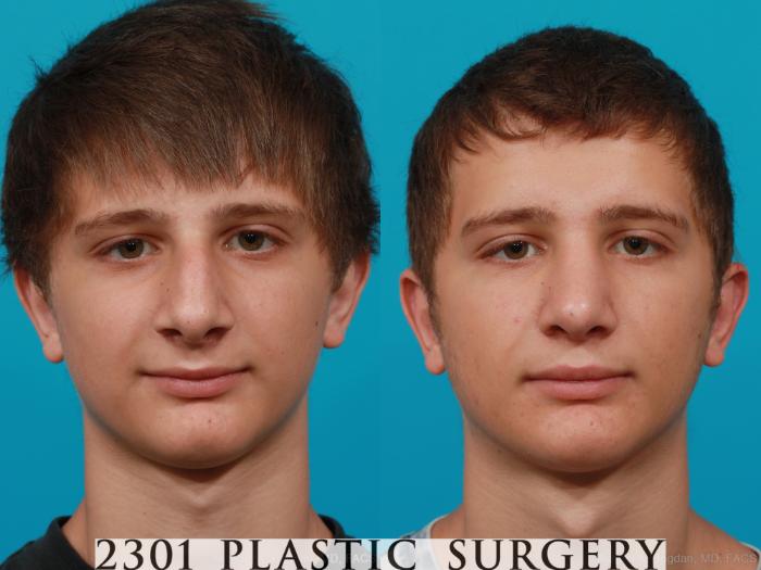 Before & After Rhinoplasty Case 182 View #1 View in Fort Worth, Plano, & Frisco, Texas