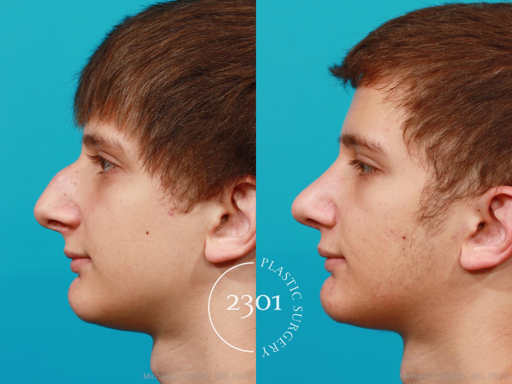 Before & After Rhinoplasty Case 182 View #2 View in Fort Worth, Plano, & Frisco, Texas