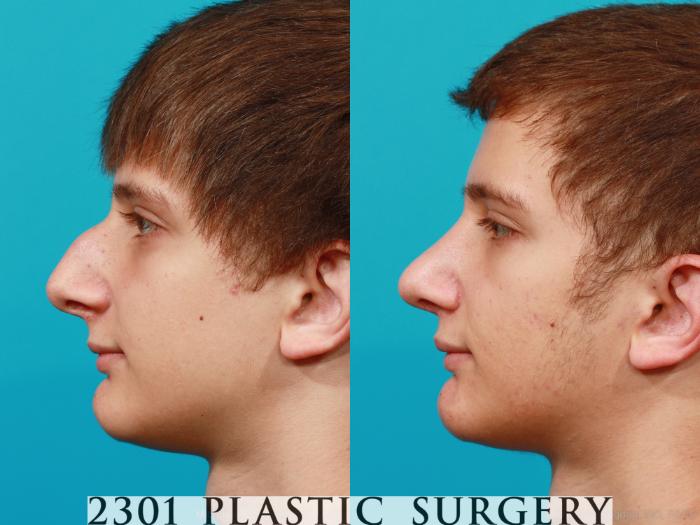 Before & After Rhinoplasty Case 182 View #2 View in Fort Worth, Plano, & Frisco, Texas