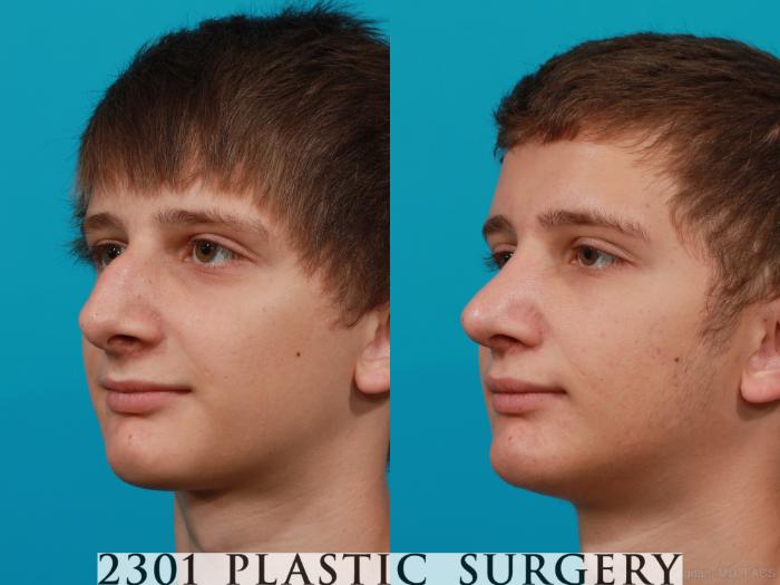 Before & After Rhinoplasty Case 182 View #3 View in Fort Worth, Plano, & Frisco, Texas
