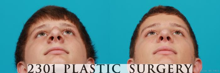 Before & After Rhinoplasty Case 182 View #4 View in Fort Worth, Plano, & Frisco, Texas