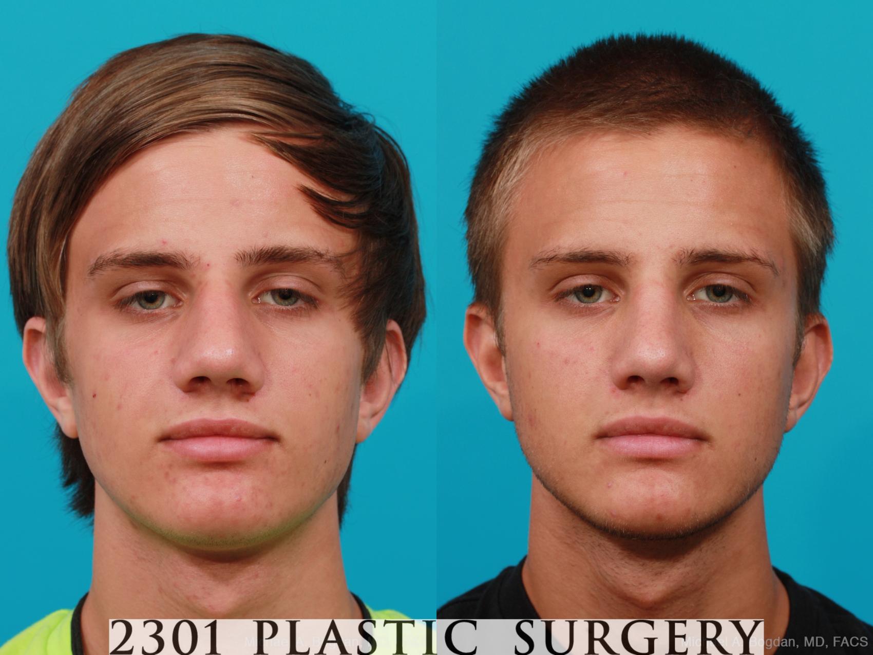 Before & After Rhinoplasty Case 184 View #1 View in Fort Worth, Plano, & Frisco, Texas