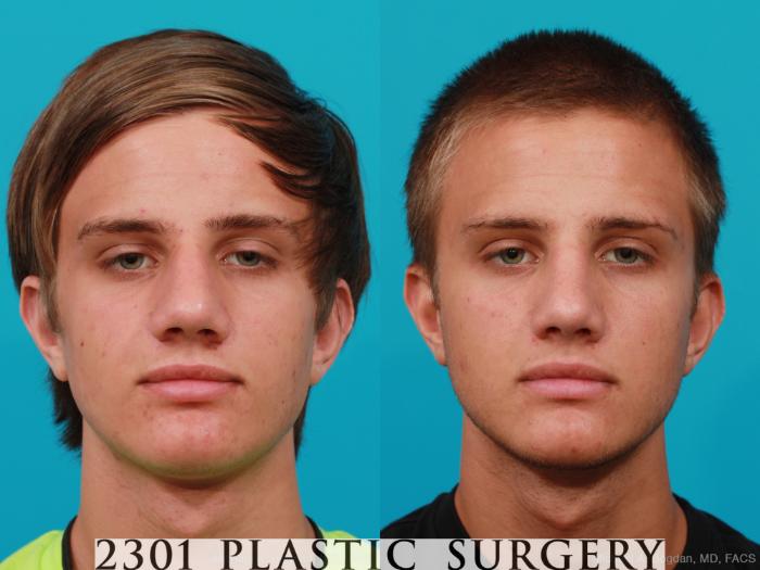Before & After Rhinoplasty Case 184 View #1 View in Fort Worth & Frisco, Texas