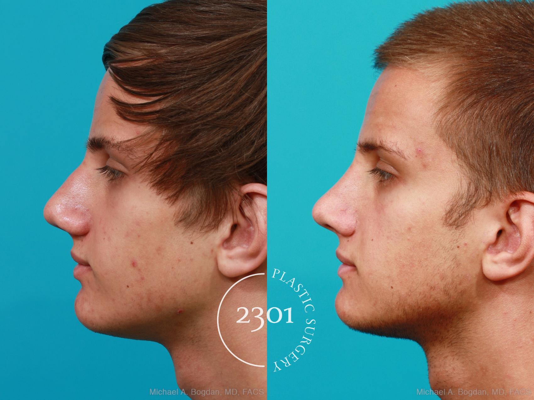 Before & After Rhinoplasty Case 184 View #2 View in Fort Worth, Plano, & Frisco, Texas
