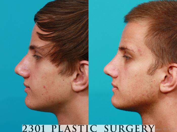 Before & After Rhinoplasty Case 184 View #2 View in Fort Worth, Plano, & Frisco, Texas