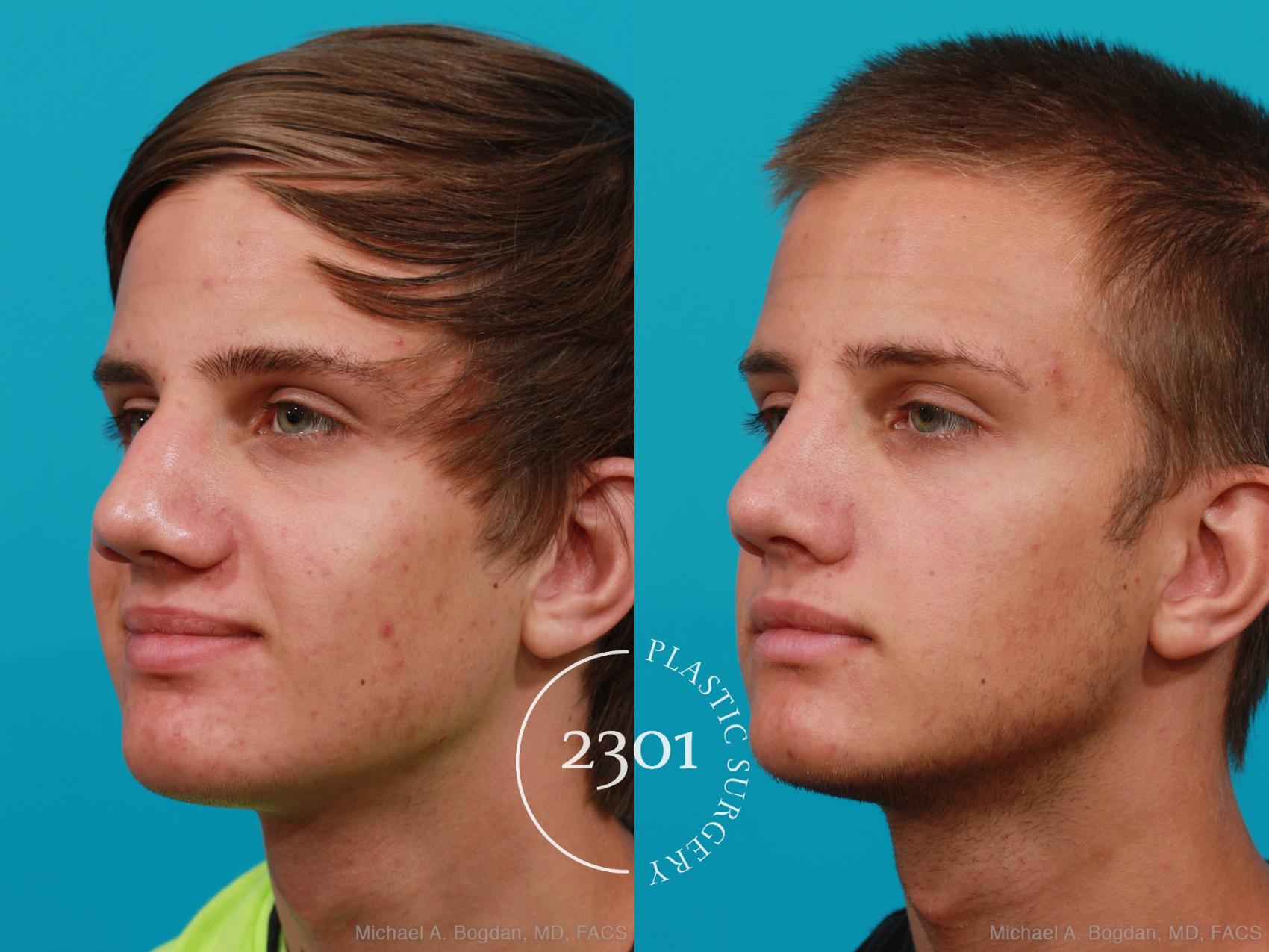 Before & After Rhinoplasty Case 184 View #3 View in Fort Worth, Plano, & Frisco, Texas