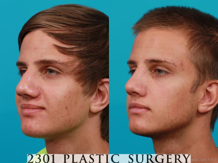 Before & After Rhinoplasty Case 184 View #3 View in Fort Worth, Plano, & Frisco, Texas
