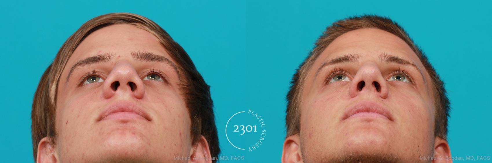 Before & After Rhinoplasty Case 184 View #4 View in Fort Worth, Plano, & Frisco, Texas