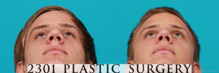 Before & After Rhinoplasty Case 184 View #4 View in Fort Worth, Plano, & Frisco, Texas