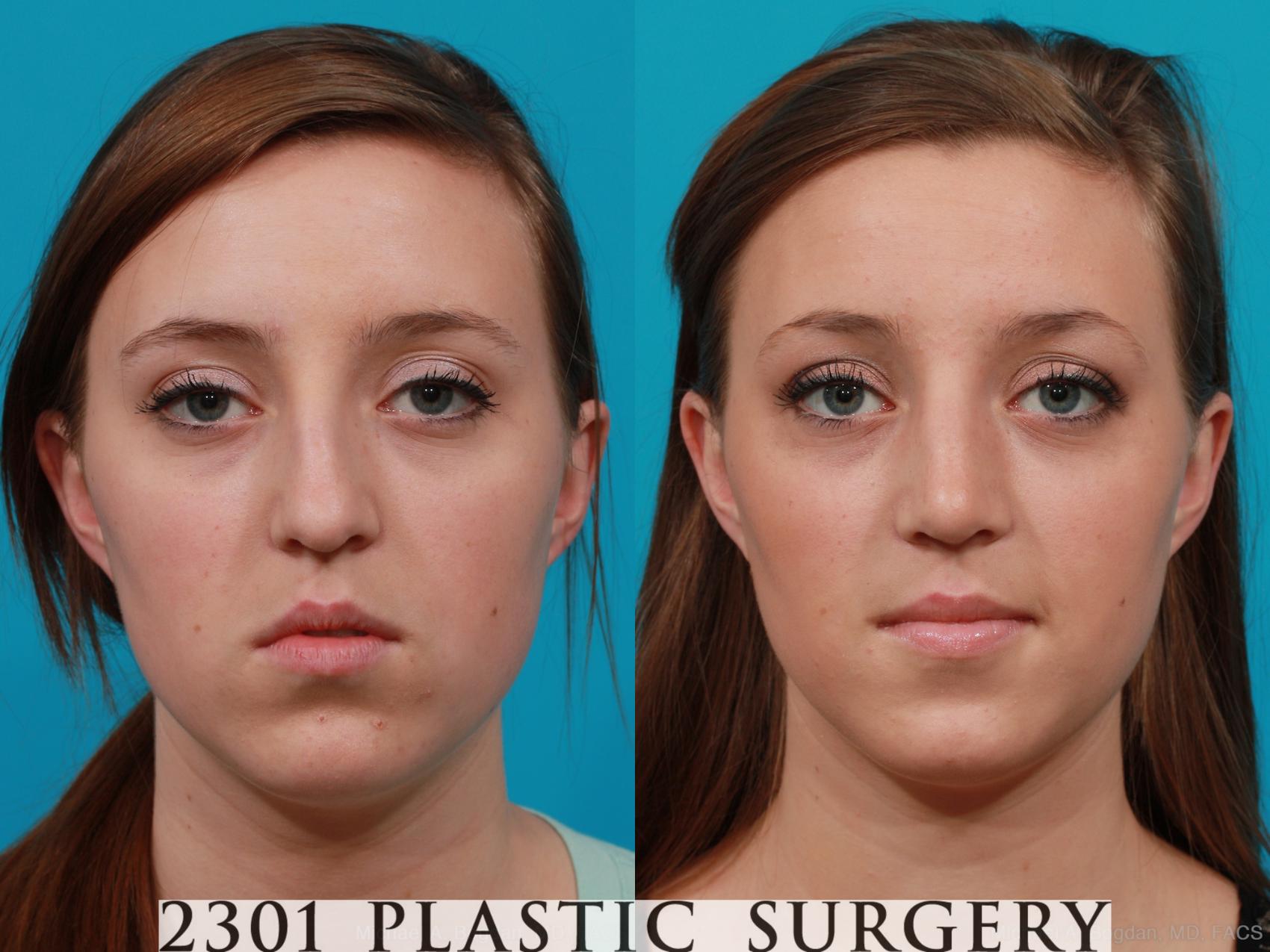 Before & After Rhinoplasty Case 197 View #1 View in Fort Worth, Plano, & Frisco, Texas