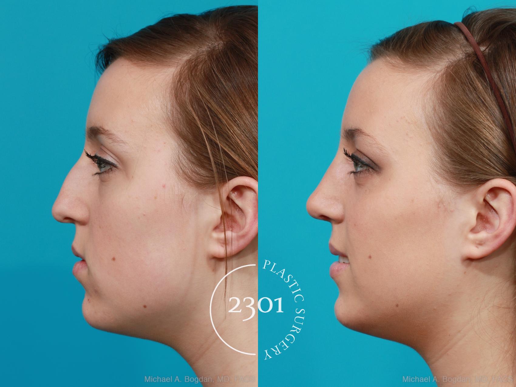 Before & After Rhinoplasty Case 197 View #2 View in Fort Worth, Plano, & Frisco, Texas