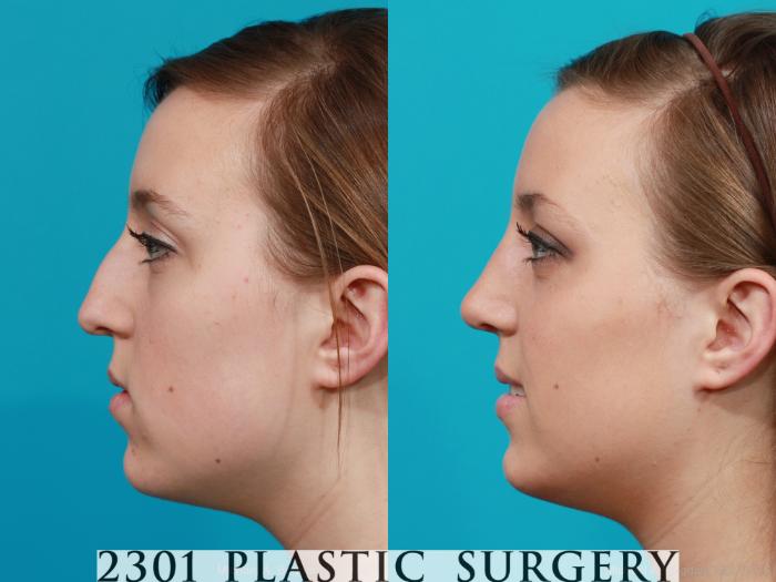 Before & After Rhinoplasty Case 197 View #2 View in Fort Worth, Plano, & Frisco, Texas