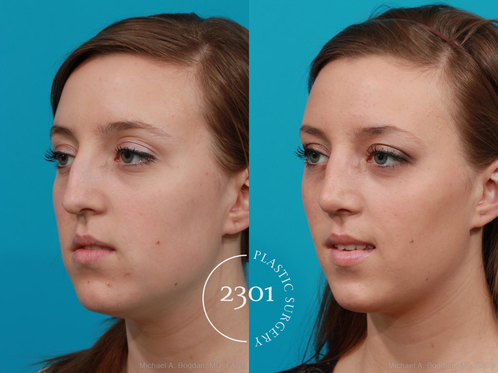 Before & After Rhinoplasty Case 197 View #3 View in Fort Worth, Plano, & Frisco, Texas