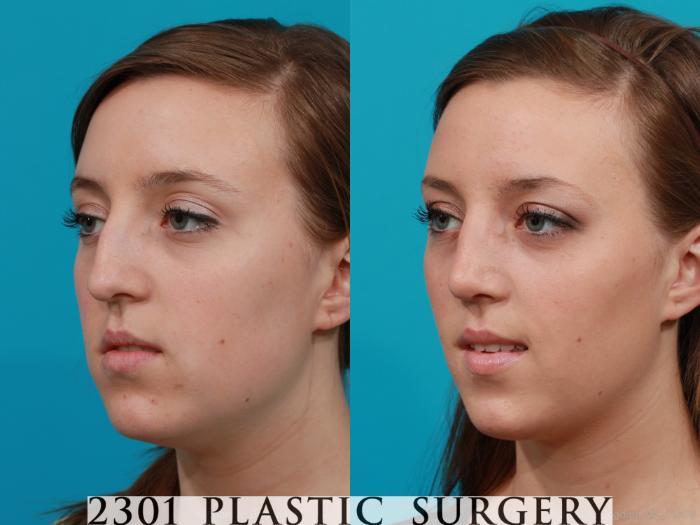 Before & After Rhinoplasty Case 197 View #3 View in Fort Worth, Plano, & Frisco, Texas