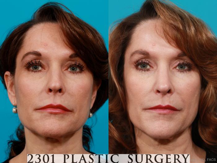 Before & After Rhinoplasty Case 198 View #1 View in Fort Worth, Plano, & Frisco, Texas