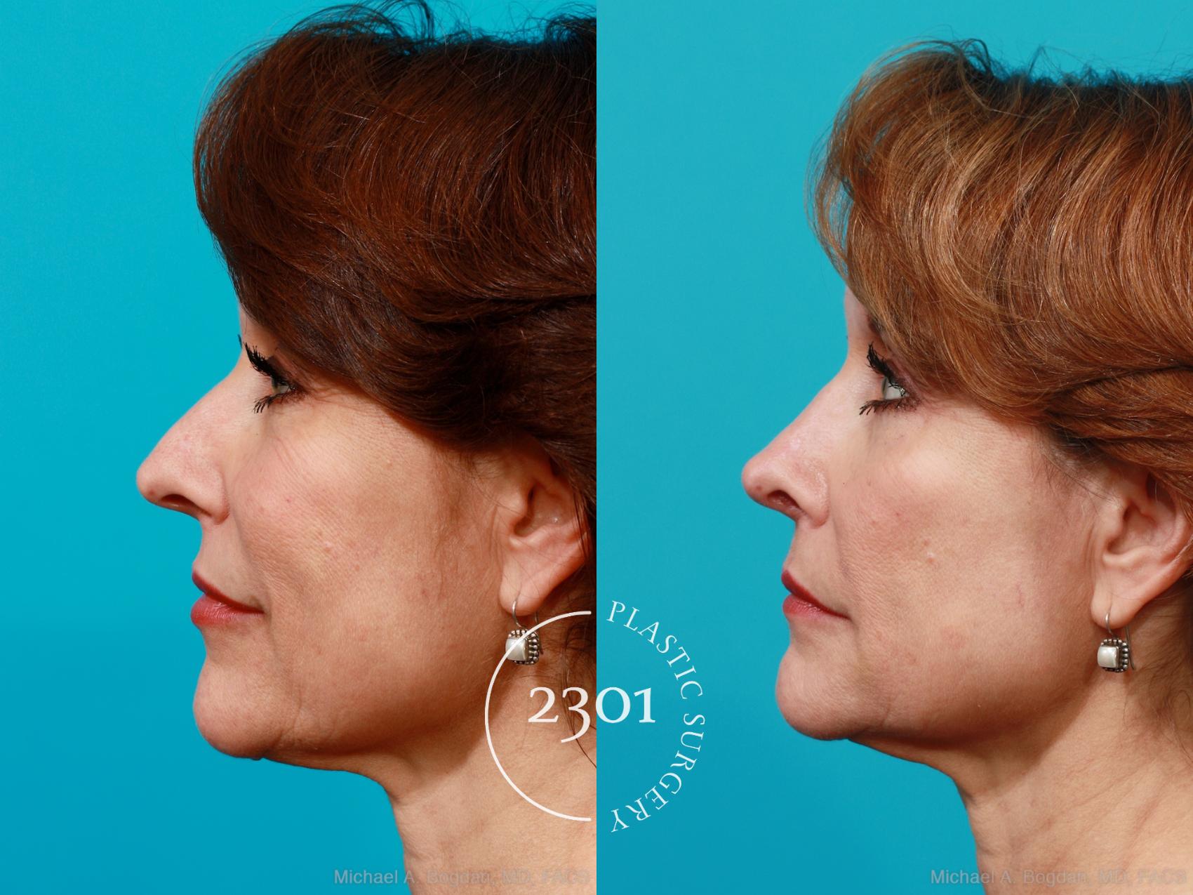 Before & After Rhinoplasty Case 198 View #2 View in Fort Worth, Plano, & Frisco, Texas