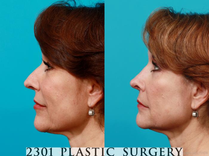 Before & After Rhinoplasty Case 198 View #2 View in Fort Worth, Plano, & Frisco, Texas