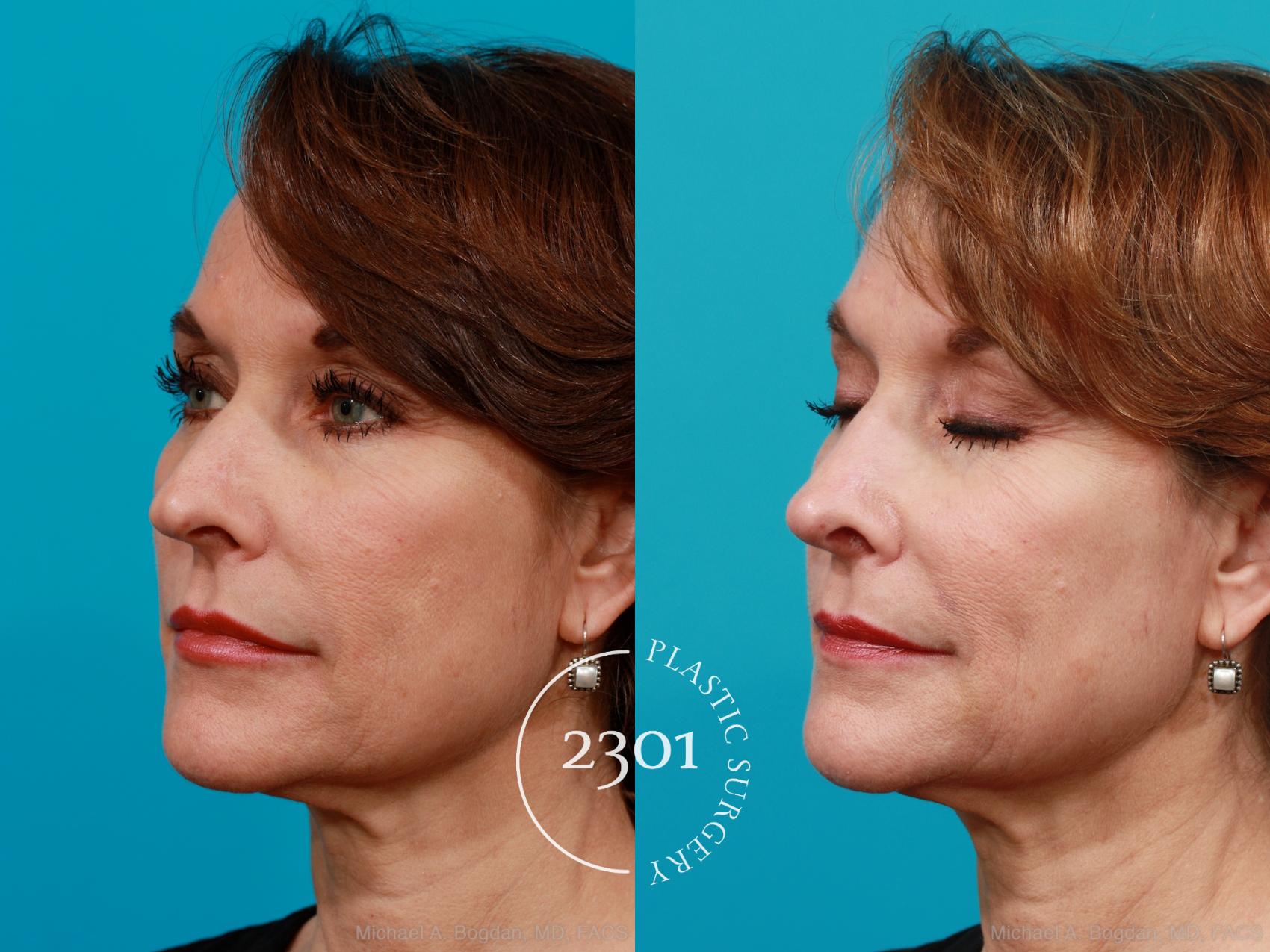 Before & After Rhinoplasty Case 198 View #3 View in Fort Worth, Plano, & Frisco, Texas