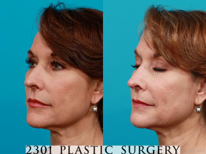 Before & After Rhinoplasty Case 198 View #3 View in Fort Worth, Plano, & Frisco, Texas