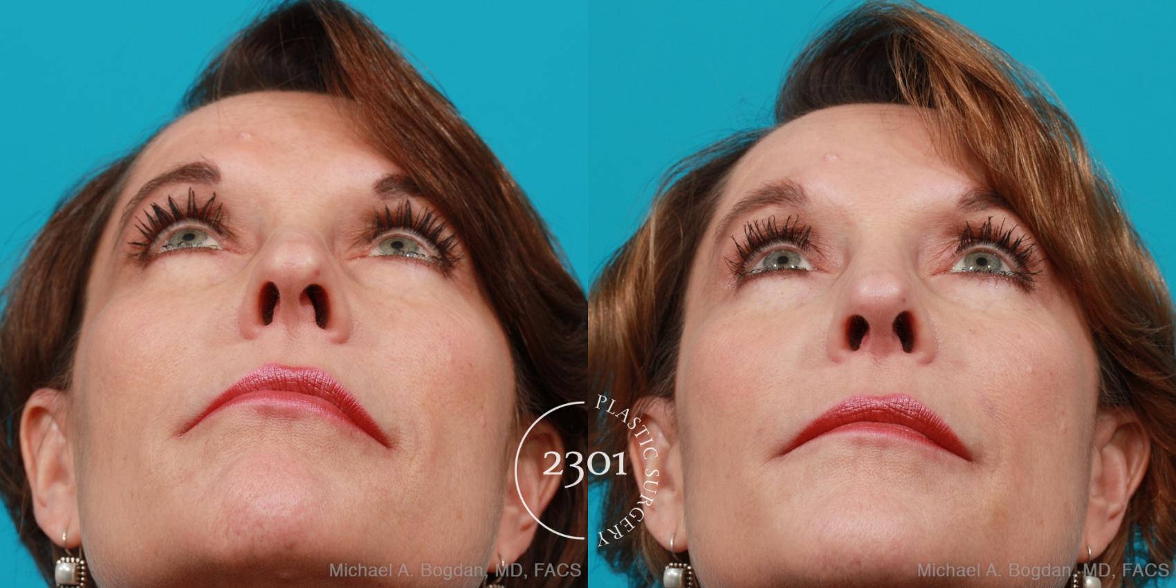 Before & After Rhinoplasty Case 198 View #4 View in Fort Worth, Plano, & Frisco, Texas
