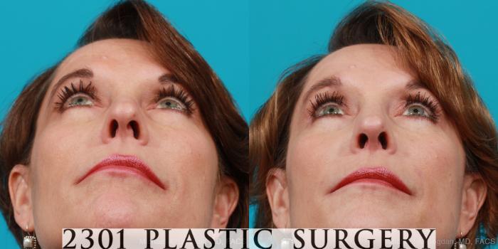 Before & After Rhinoplasty Case 198 View #4 View in Fort Worth, Plano, & Frisco, Texas