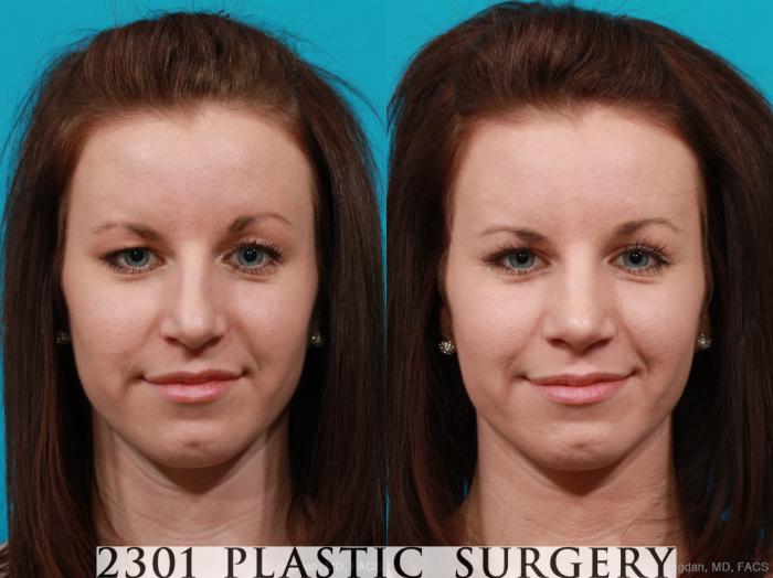 Before & After Rhinoplasty Case 213 View #1 View in Fort Worth & Frisco, Texas