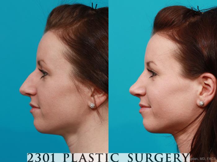 Before & After Rhinoplasty Case 213 View #2 View in Fort Worth, Plano, & Frisco, Texas