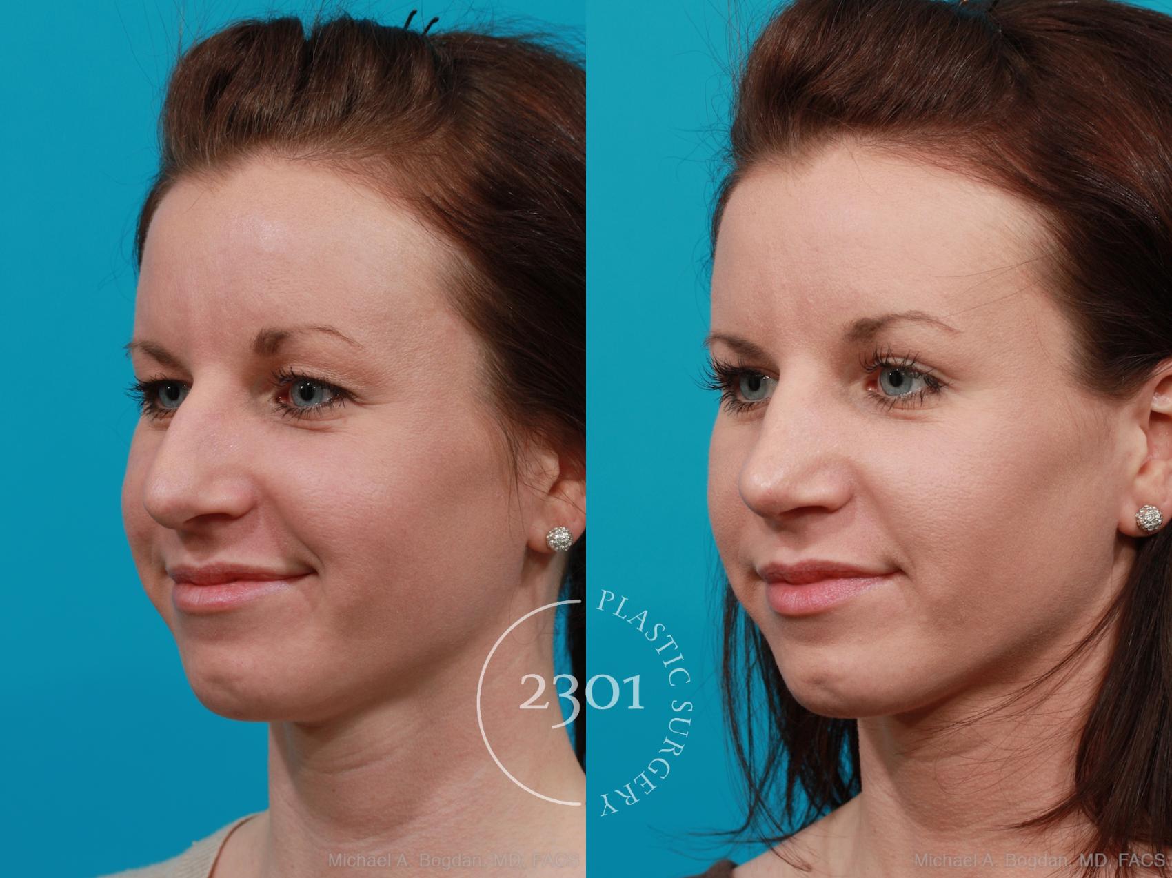 Before & After Rhinoplasty Case 213 View #3 View in Fort Worth, Plano, & Frisco, Texas