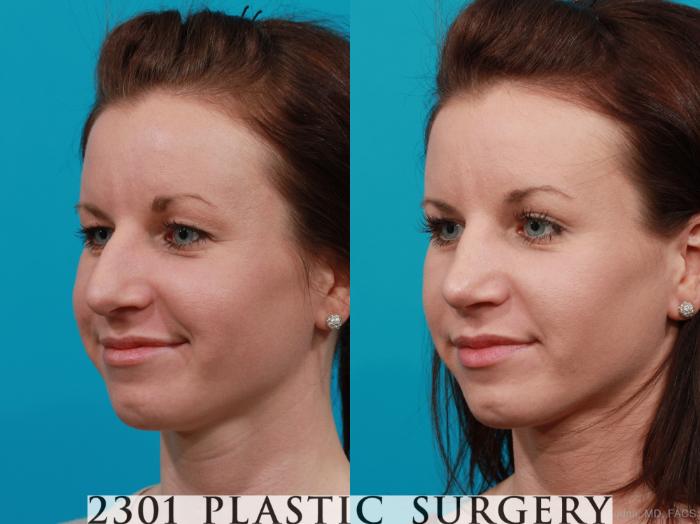 Before & After Blepharoplasty Case 213 View #3 View in Fort Worth, Plano, & Frisco, Texas