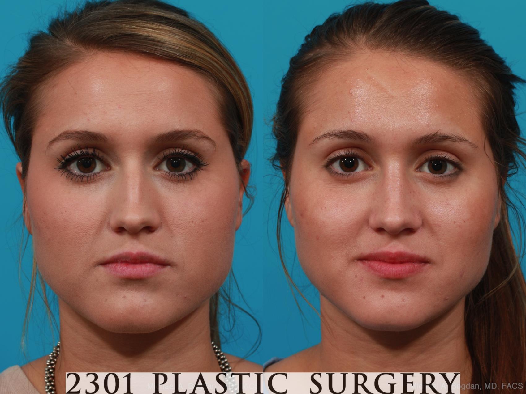 Before & After Rhinoplasty Case 251 View #1 View in Fort Worth & Frisco, Texas
