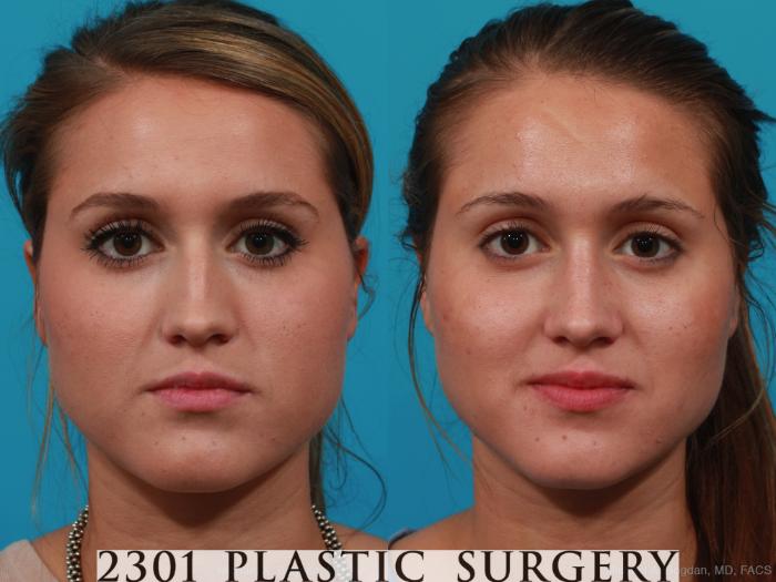Before & After Rhinoplasty Case 251 View #1 View in Fort Worth, Plano, & Frisco, Texas