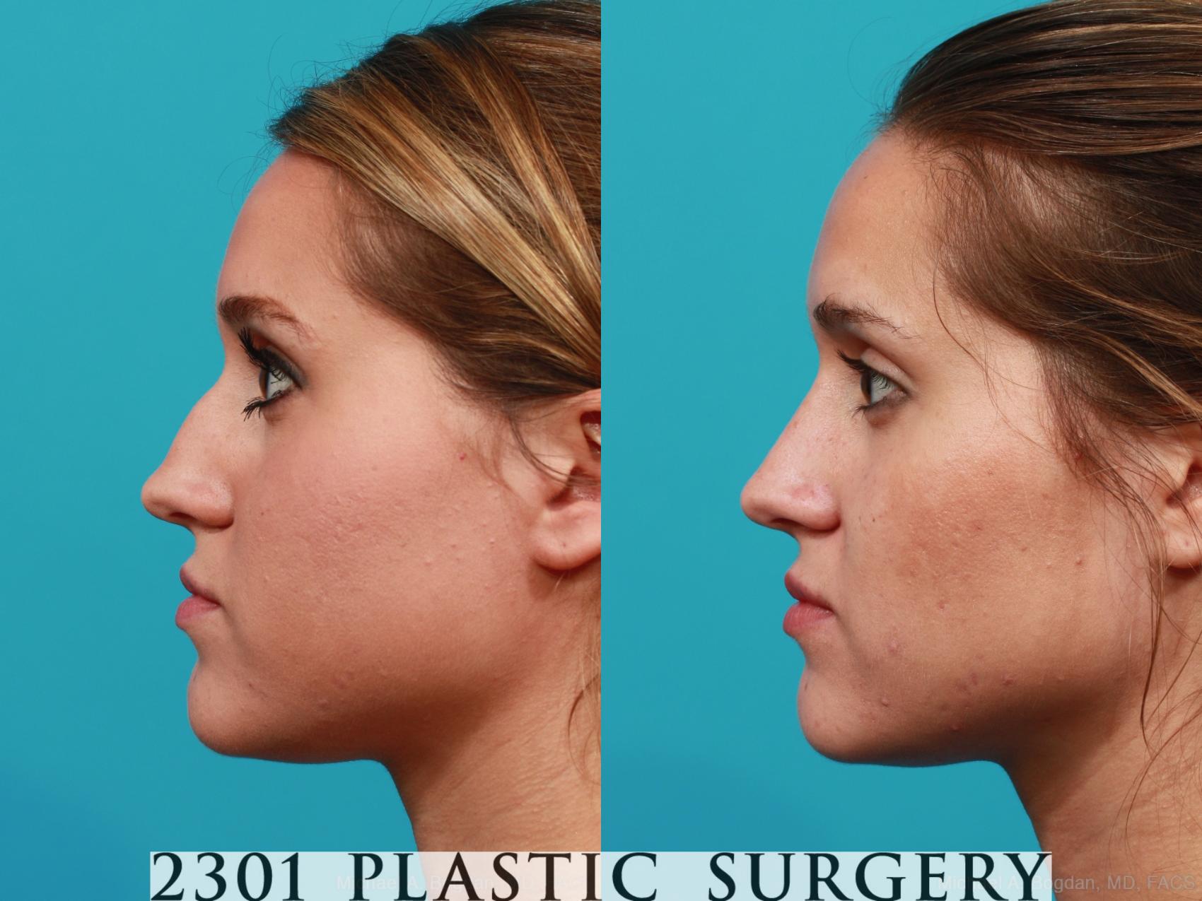 Before & After Rhinoplasty Case 251 View #2 View in Fort Worth & Frisco, Texas