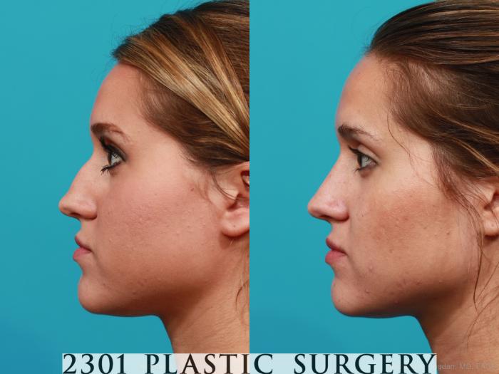 Before & After Rhinoplasty Case 251 View #2 View in Fort Worth, Plano, & Frisco, Texas