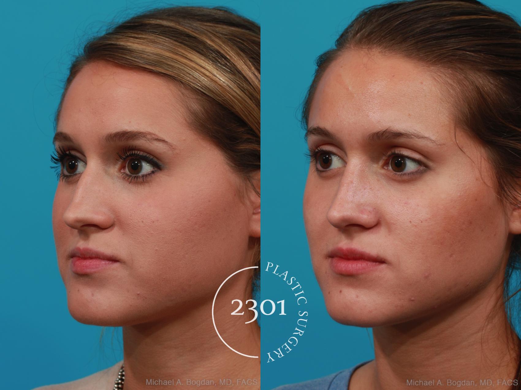 Before & After Rhinoplasty Case 251 View #3 View in Fort Worth, Plano, & Frisco, Texas