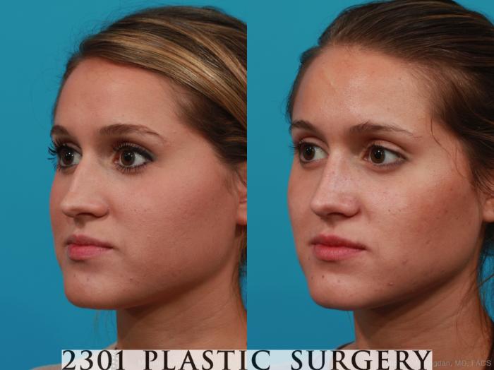 Before & After Rhinoplasty Case 251 View #3 View in Fort Worth, Plano, & Frisco, Texas