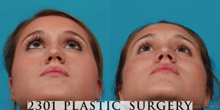 Before & After Rhinoplasty Case 251 View #4 View in Fort Worth, Plano, & Frisco, Texas