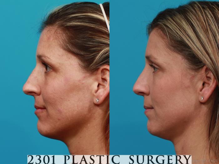 Before & After Rhinoplasty Case 280 View #2 View in Fort Worth, Plano, & Frisco, Texas