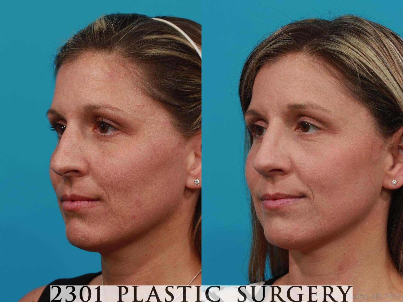 Before & After Rhinoplasty Case 280 View #3 View in Fort Worth & Frisco, Texas